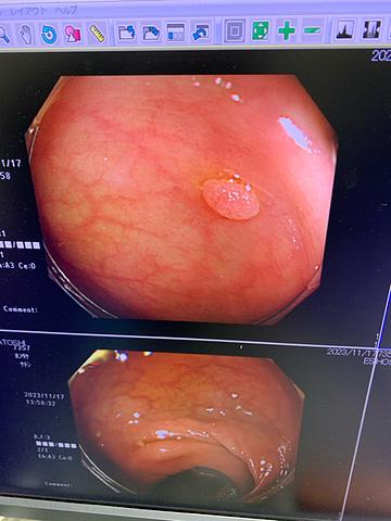 大腸ポリープ取った