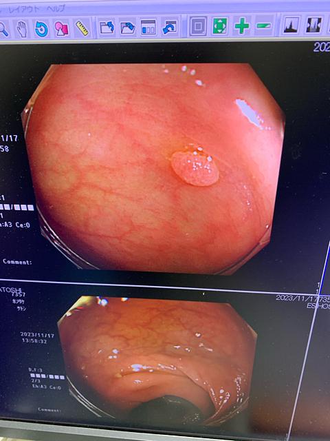 大腸ポリープ取った