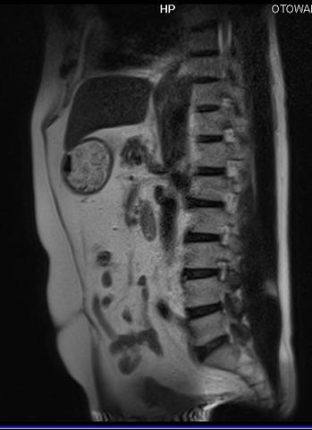 腰椎椎間板ヘルニア