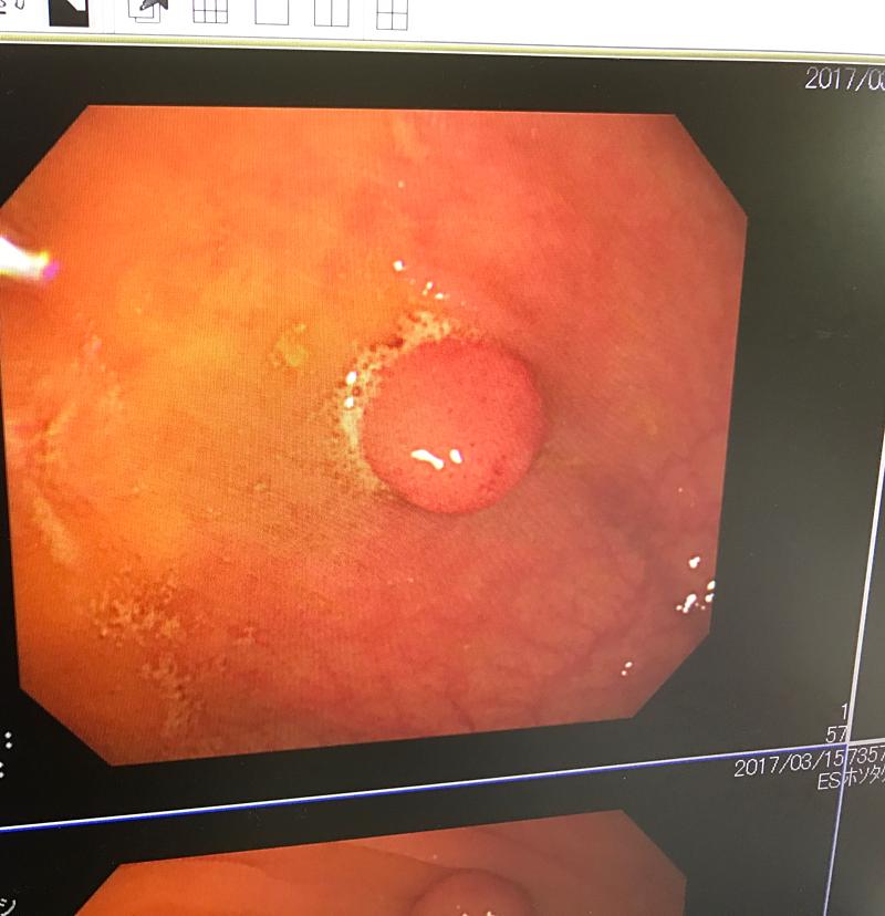 大腸ポリープ検査の結果