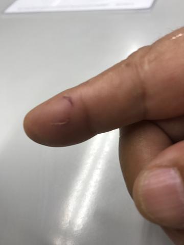 うさぎに噛まれた傷痕！