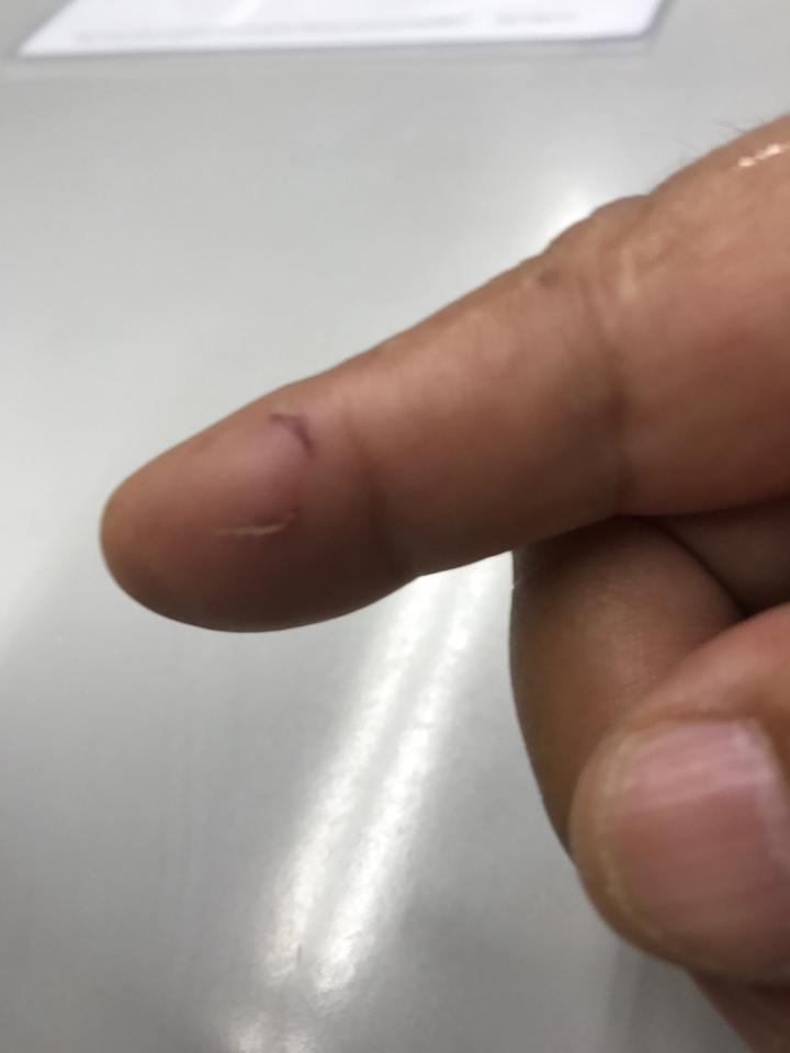 うさぎに噛まれた傷痕！